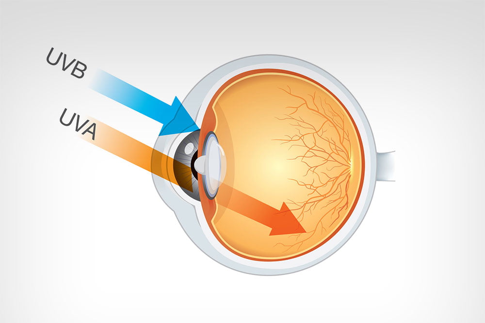 Enquanto os raios UVB danificam a córnea e o cristalino, que fazem a absorção das luzes em nossos olhos. A incidência de raios UVB no cristalino aumenta a possibilidade de se desenvolver catarata nos olhos.